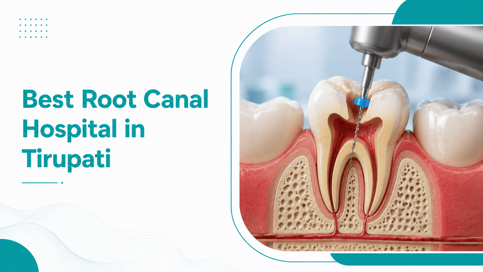 Best Root Canal Hospital in Tirupati