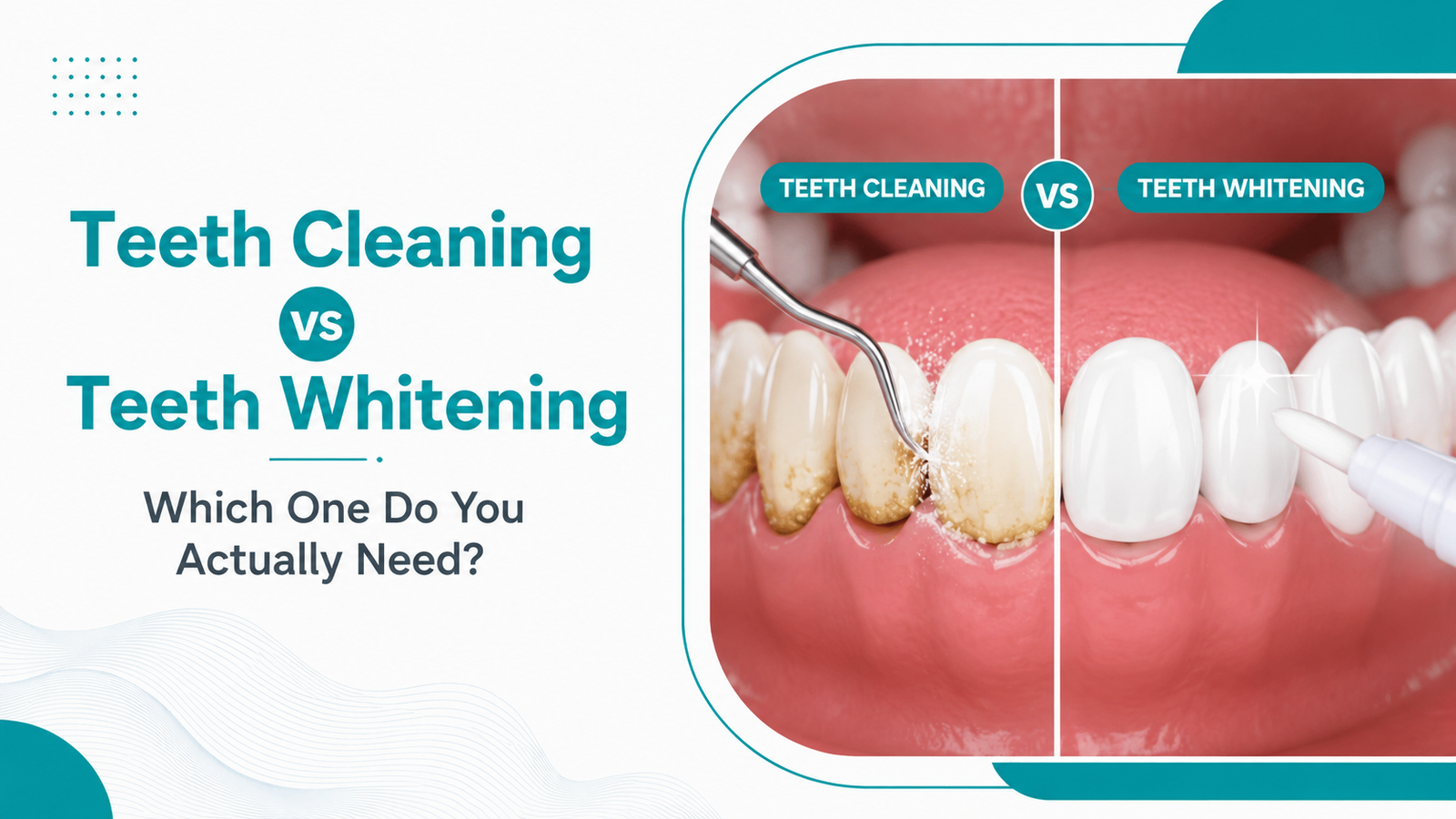 Teeth Cleaning vs Teeth Whitening: What's the Difference