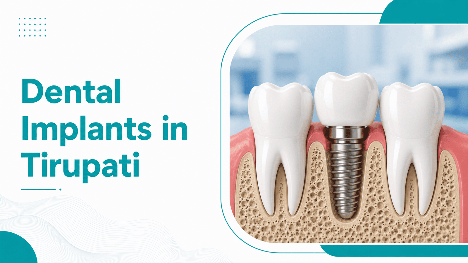 Dental Implants in Tirupati | Cost, Types & Procedure 2026 