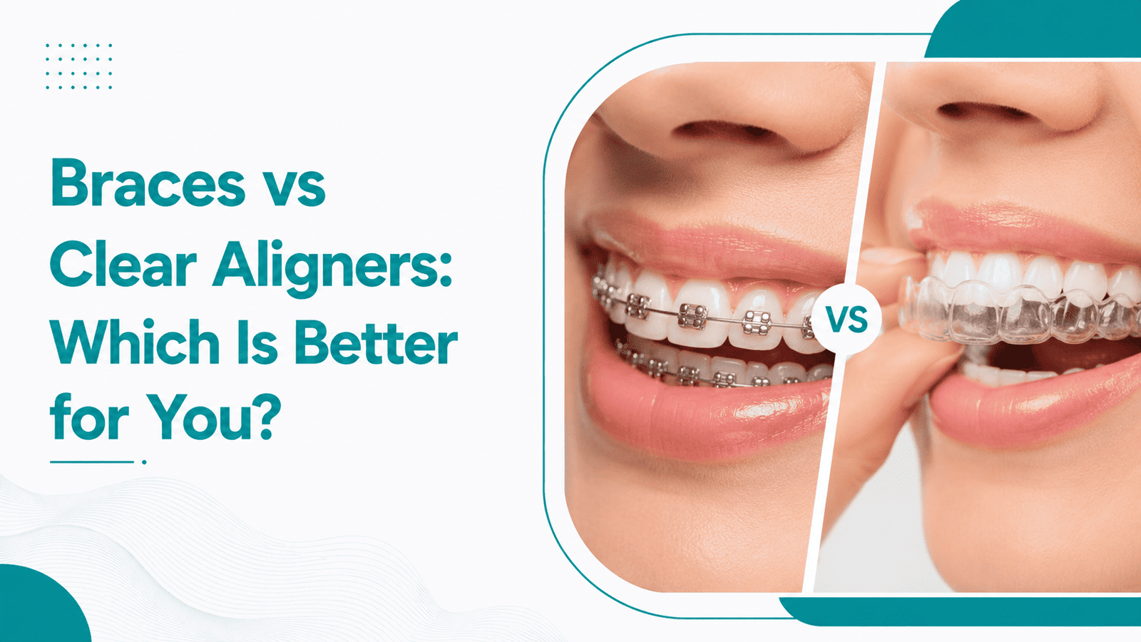Braces vs Clear Aligners 2026 — Cost, Comfort, Results  