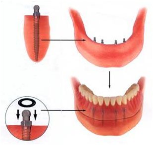 Implant-retained overdenture diagram — a full arch stabilised on multiple implants for a fixed-feel restoration
