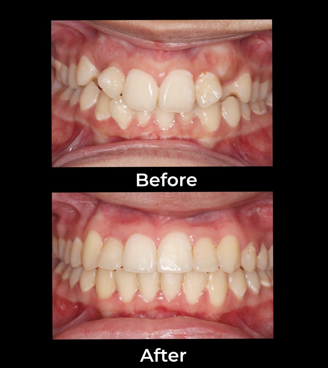 Before & after: severely crowded teeth aligned to a straight, even smile