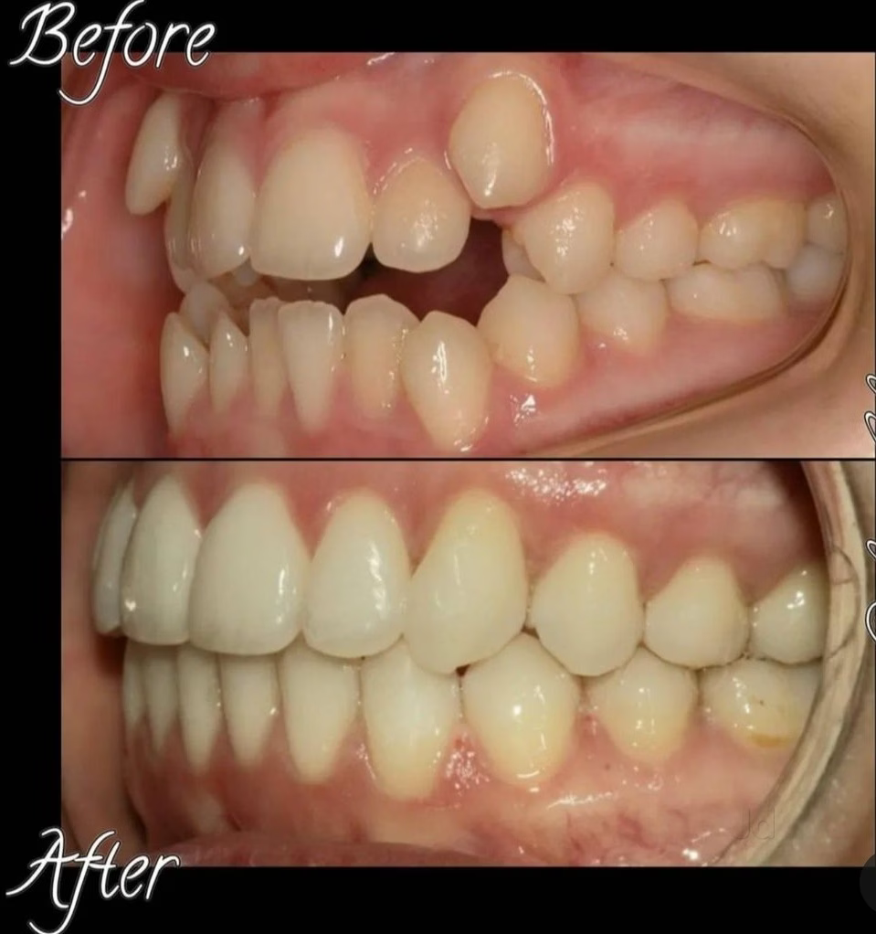 Before & after (side profile): bite and alignment corrected