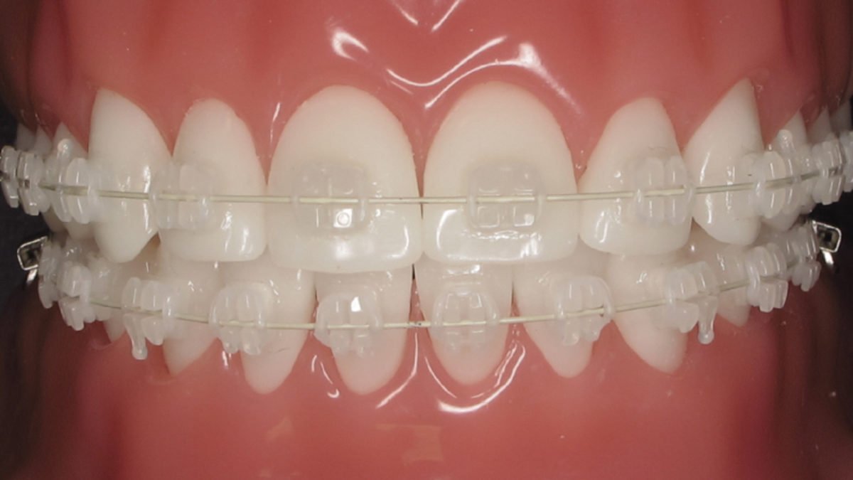 Orthodontic Braces