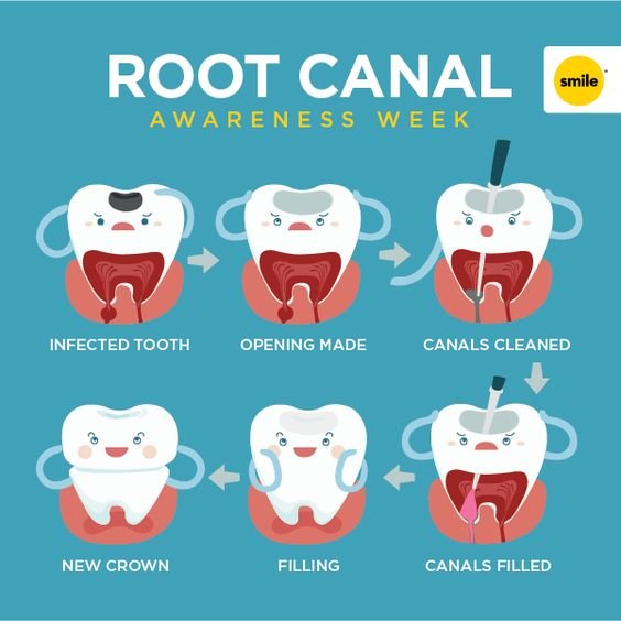 Step-by-step RCT — opening, cleaning, filling and crown