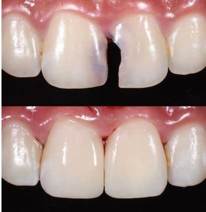 Dental Fillings