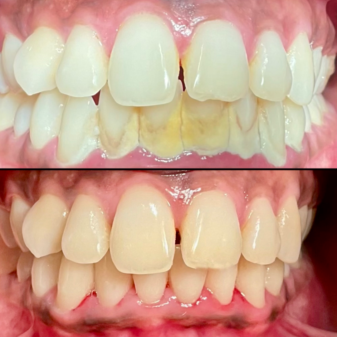 Gum Treatment