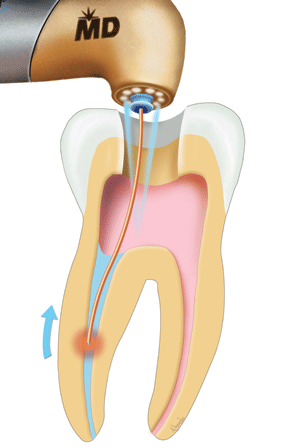 Laser canal disinfection — killing bacteria in hard-to-reach areas