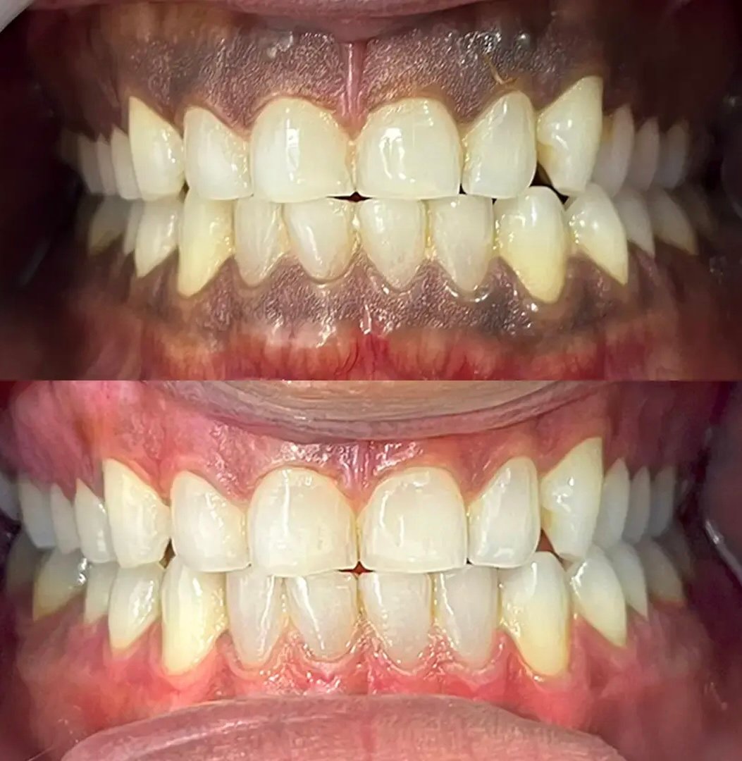 Laser gum depigmentation — removing dark pigmentation for a healthy pink smile
