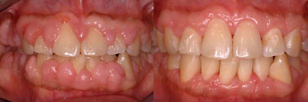 Laser flap surgery — before and after results