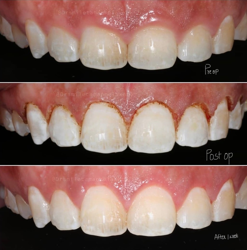 Laser gingivectomy — precise gum reshaping
