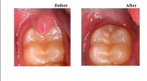 Operculectomy with laser — wisdom tooth gum flap removal
