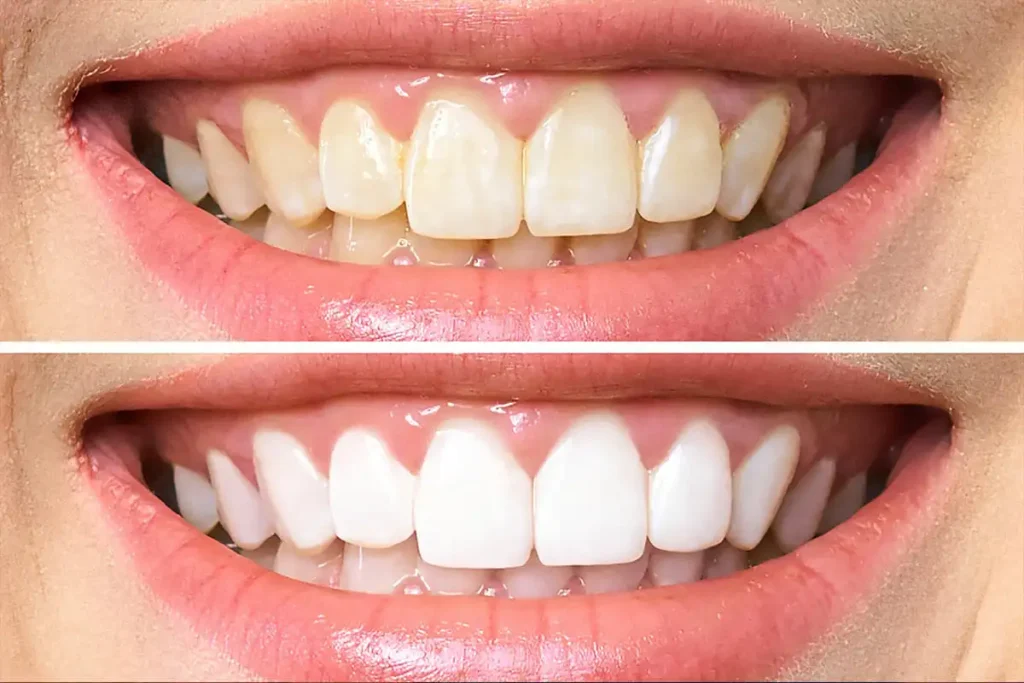 Laser teeth whitening — dramatically brighter results in a single visit