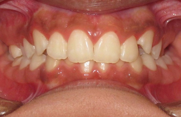 Deep bite — upper front teeth excessively overlap the lower