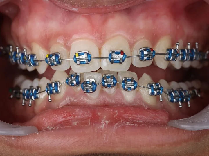 Orthodontic Treatment