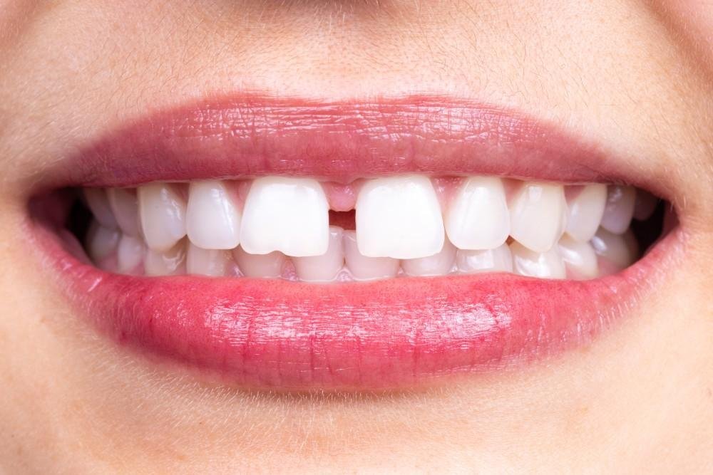 Midline diastema — gap between the upper front teeth