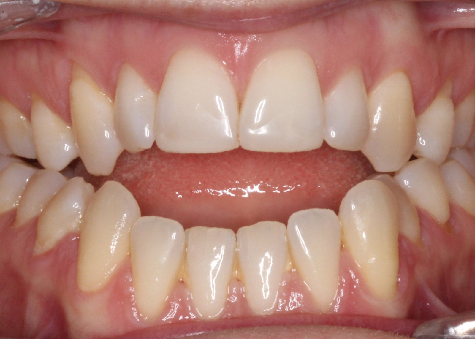 Open bite — front teeth do not meet when mouth is closed