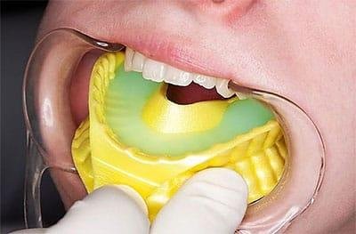 Fluoride varnish application — protecting young teeth from decay