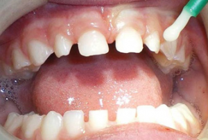 Pediatric Dentistry