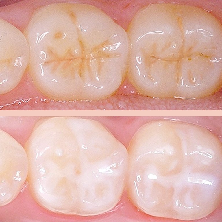 Pit and fissure sealant — sealing molar grooves to prevent cavities