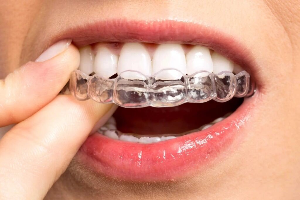 Clear Aligners & Invisalign