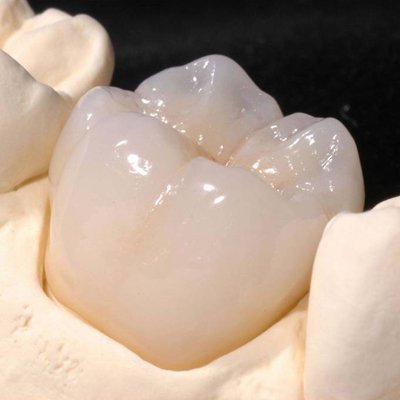 Zirconia crown — used in the final reconstructive phase for natural aesthetics & strength