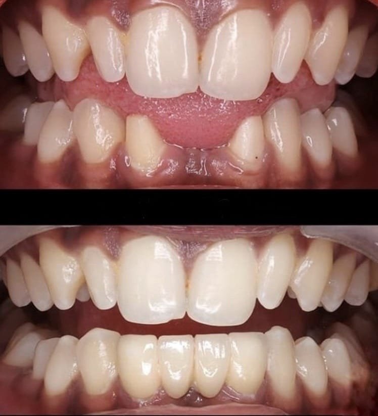 Before & after: misaligned, gappy front teeth realigned and brightened for an even, harmonious smile line