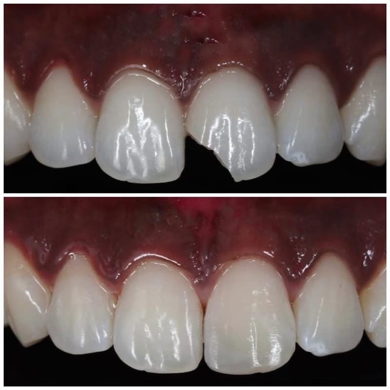Before & after: chipped front tooth rebuilt with direct composite bonding in a single visit