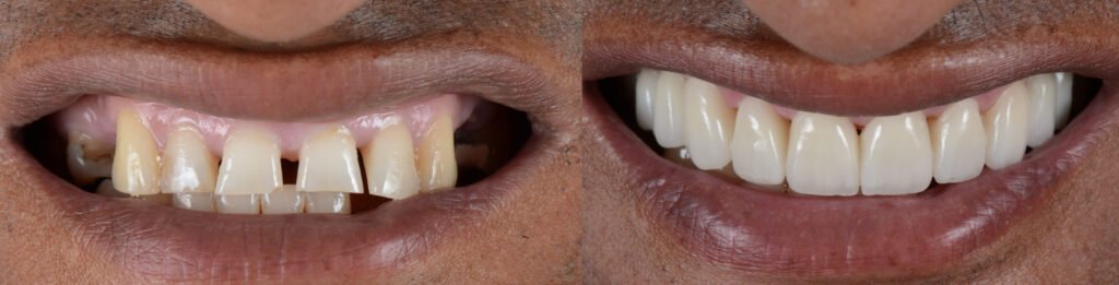 Before & after: gappy, discoloured front teeth transformed into an even, brighter smile