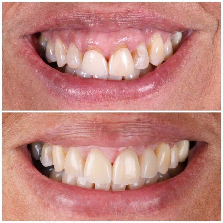Before & after: missing and damaged teeth restored with implant-supported crowns