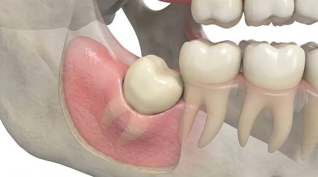 Tooth Extraction