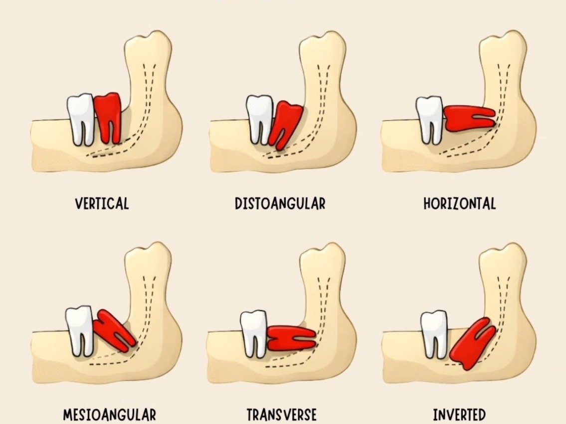 Six classifications of wisdom tooth impaction — vertical, distoangular, horizontal, mesioangular, transverse, inverted