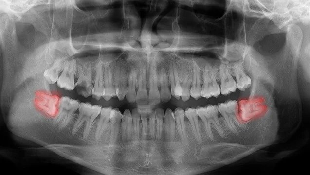 OPG panoramic X-ray showing both lower impacted wisdom teeth — pre-surgical planning